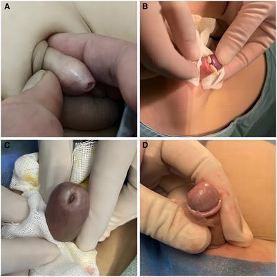 Optimizing treatment strategies for pediatric phimosis and redundant prepuce: a comparative study of traditional circumcision and disposable circumcision stapler